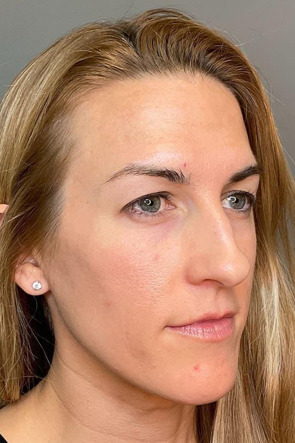 Apr&egrave;s HydraFacial &eacute;clat teint &mdash; Institut V Esth&eacute;tique Montr&eacute;al