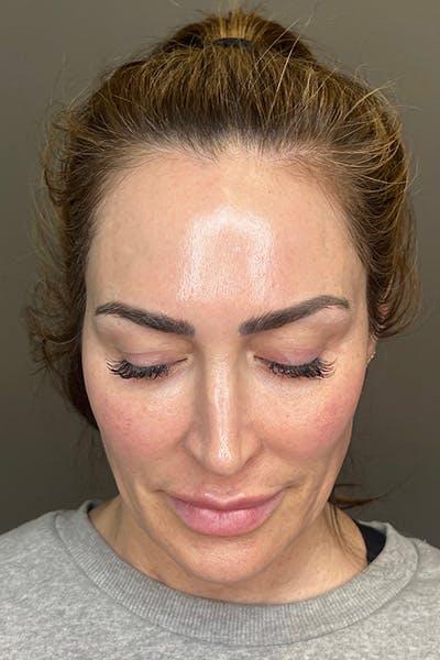 Apr&egrave;s HydraFacial anti-&acirc;ge &mdash; Institut V Esth&eacute;tique Montr&eacute;al