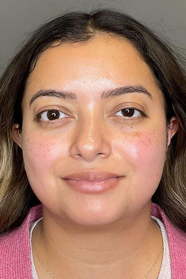 Avant HydraFacial &Eacute;clat et Hydratation &mdash; Institut V Esth&eacute;tique Montr&eacute;al
