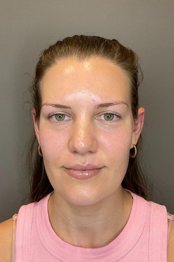 Apr&egrave;s HydraFacial Signature teint &eacute;clatant &mdash; Institut V Esth&eacute;tique Montr&eacute;al