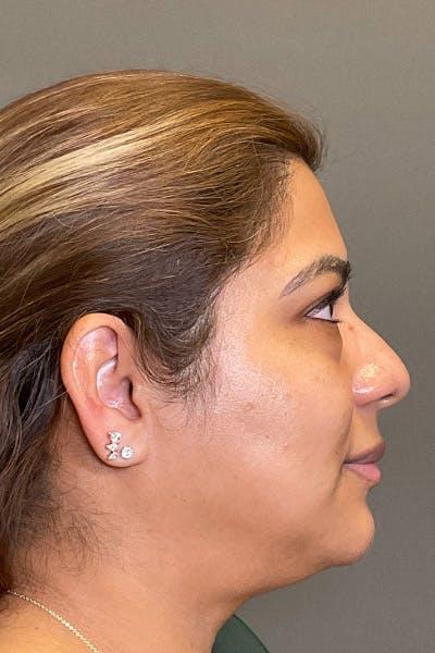 Apr&egrave;s HydraFacial pores raffin&eacute;s &mdash; Institut V Esth&eacute;tique Montr&eacute;al