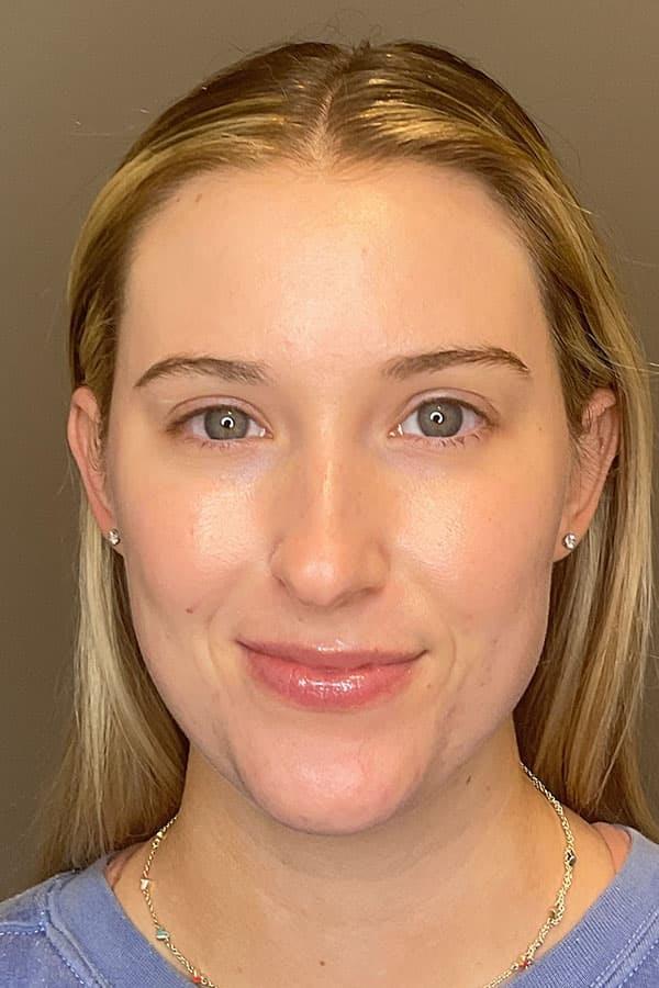 Apr&egrave;s HydraFacial Signature pores raffin&eacute;s &mdash; Institut V Esth&eacute;tique Montr&eacute;al