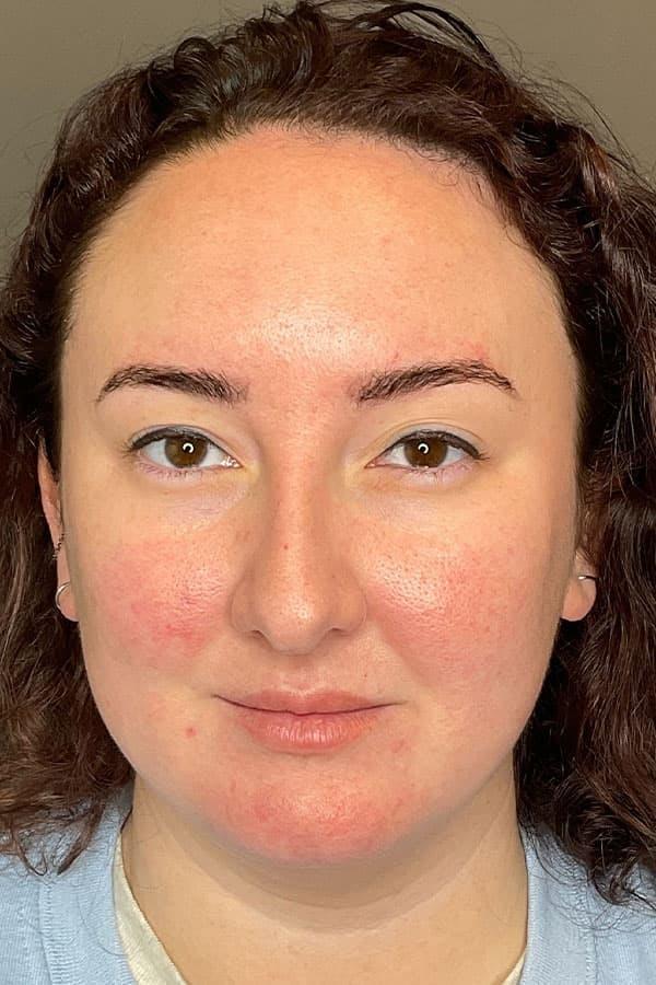 Apr&egrave;s HydraFacial am&eacute;lioration texture &mdash; Institut V Esth&eacute;tique Montr&eacute;al