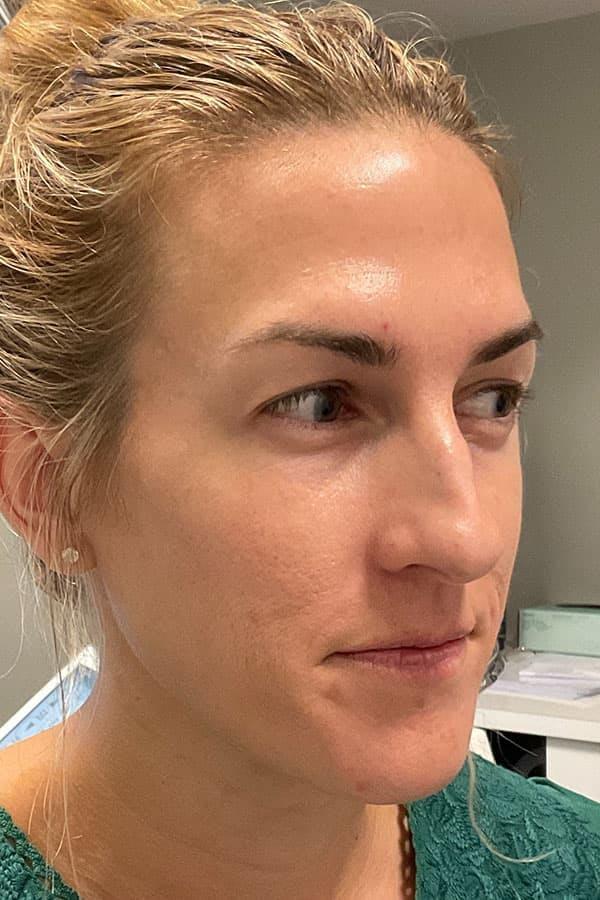 Avant HydraFacial teint terne &mdash; Institut V Esth&eacute;tique Montr&eacute;al