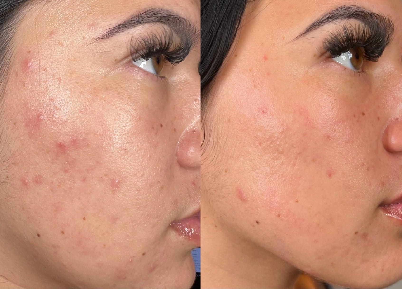 Résultat HydraFacial acné imperfections avant et après — Institut V Esthétique Montréal