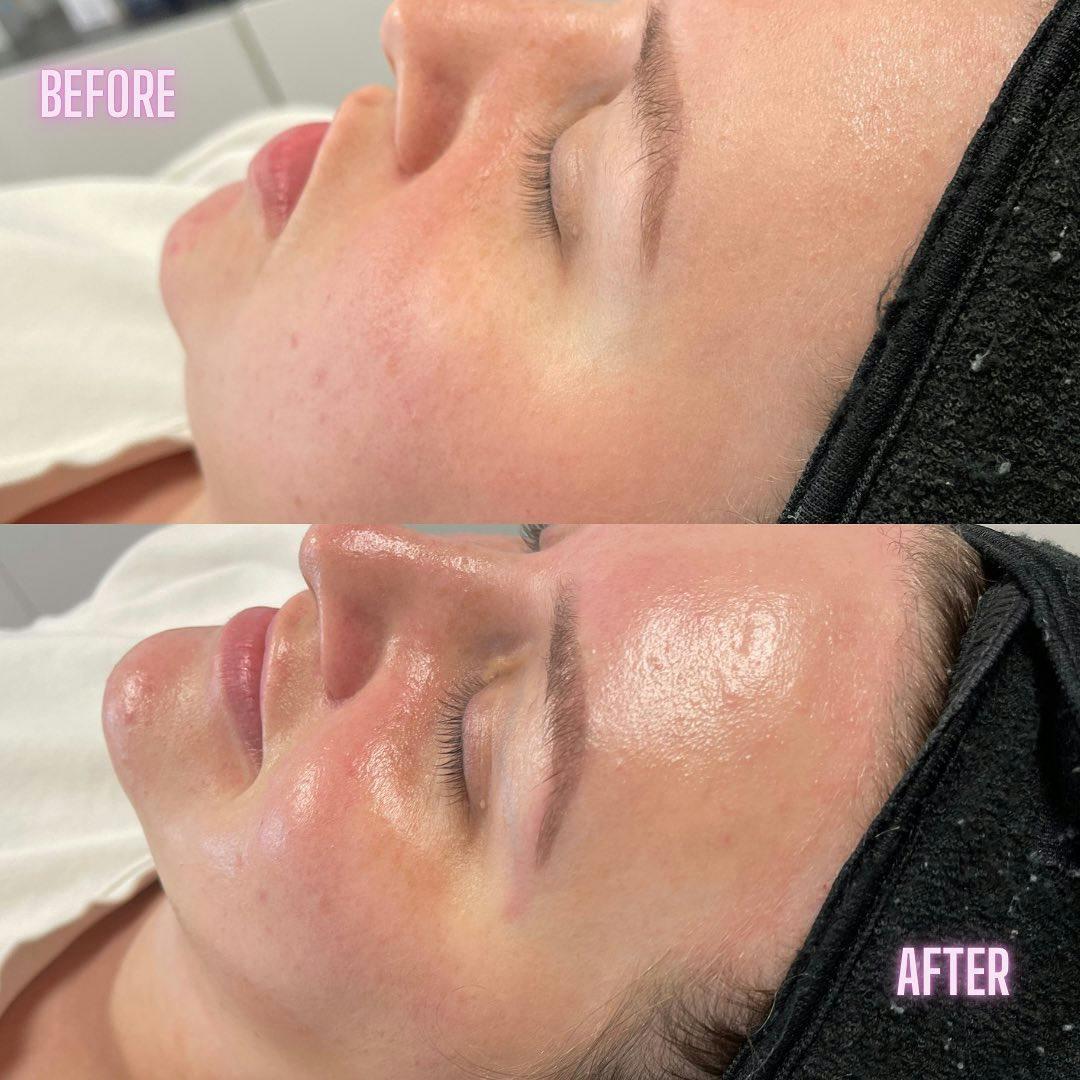 R&eacute;sultat HydraFacial Hydratation Intense &mdash; Institut V Esth&eacute;tique Montr&eacute;al