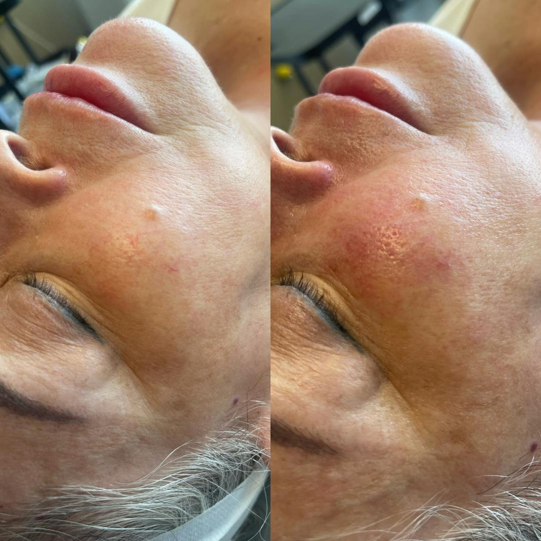 R&eacute;sultat HydraFacial Luminosit&eacute; Retrouv&eacute;e &mdash; Institut V Esth&eacute;tique Montr&eacute;al