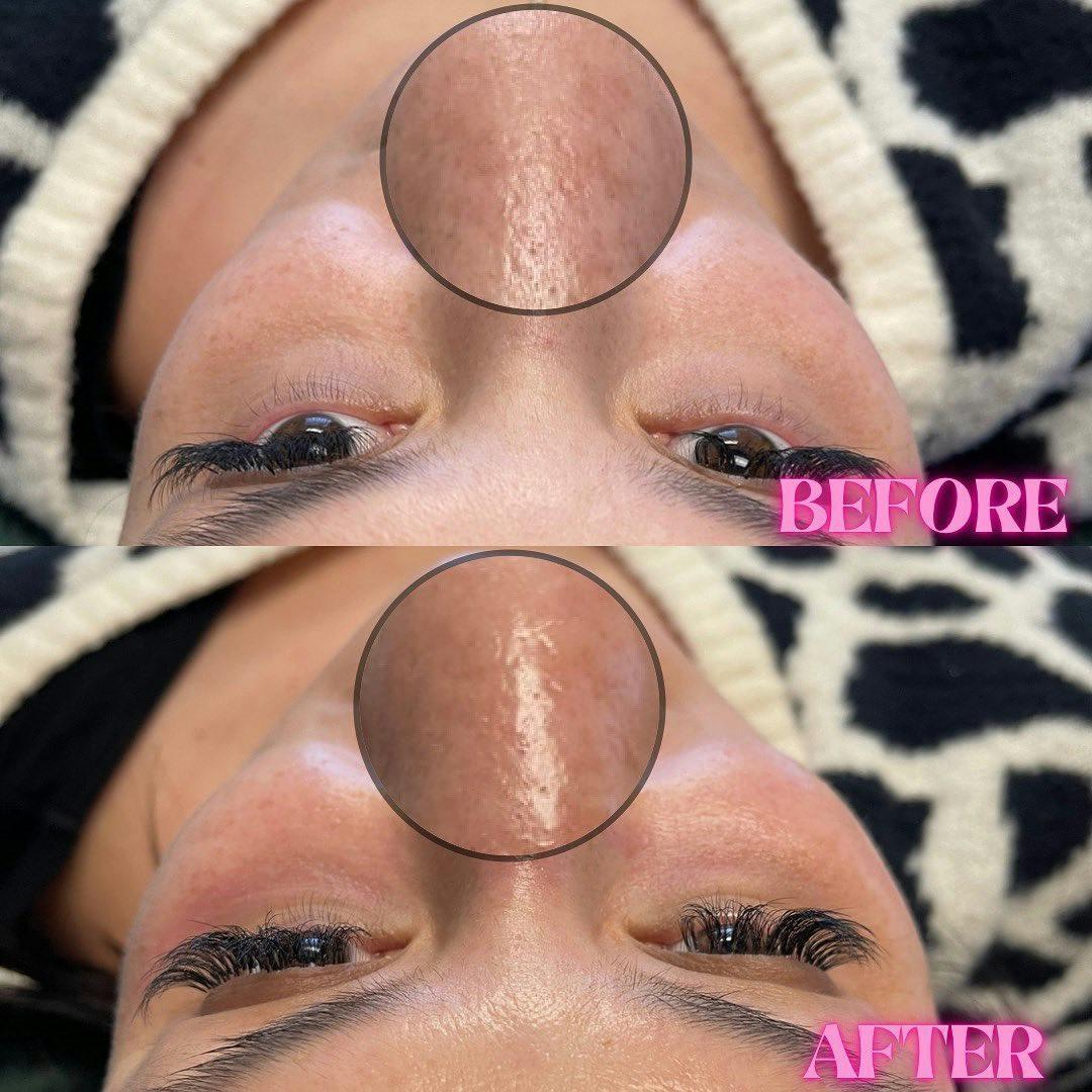 R&eacute;sultat HydraFacial Rafra&icirc;chissement Global &mdash; Institut V Esth&eacute;tique Montr&eacute;al