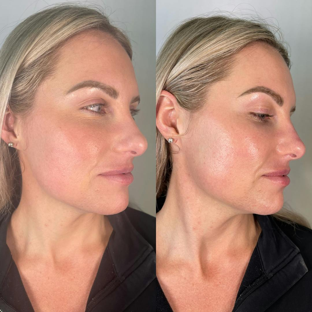 Résultat HydraFacial éclat luminosité avant et après — Institut V Esthétique Montréal