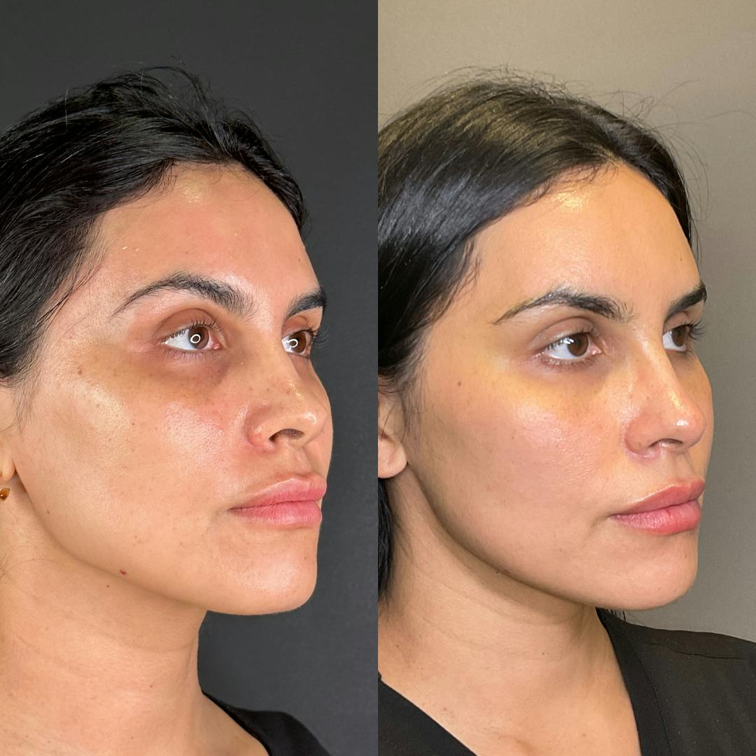 R&eacute;sultat HydraFacial Revitalisation du Teint &mdash; Institut V Esth&eacute;tique Montr&eacute;al