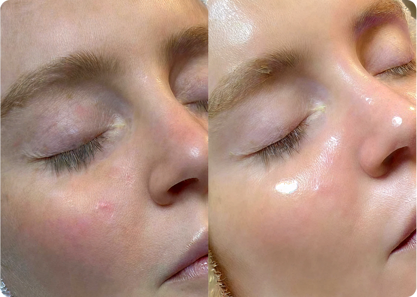 Résultat HydraFacial peau terne hydratation avant et après — Institut V Esthétique Montréal