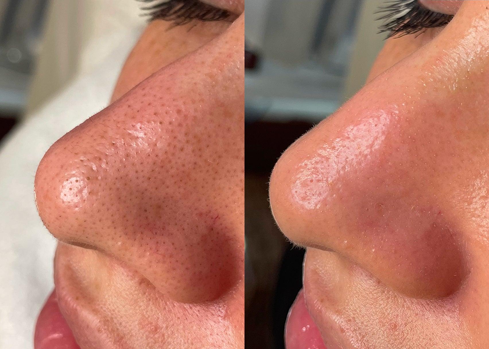 Résultat HydraFacial pores obstrués avant et après — Institut V Esthétique Montréal