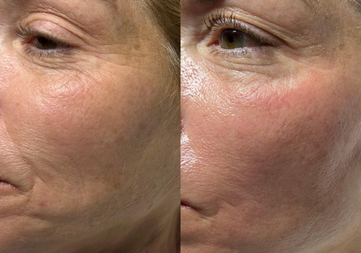 Résultat HydraFacial rides fines avant et après — Institut V Esthétique Montréal