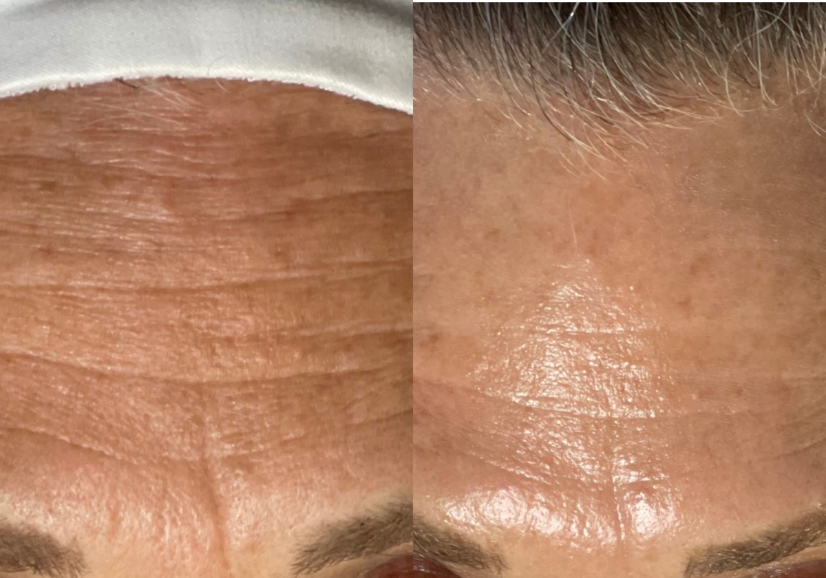 Résultat HydraFacial anti-âge avant et après — Institut V Esthétique Montréal