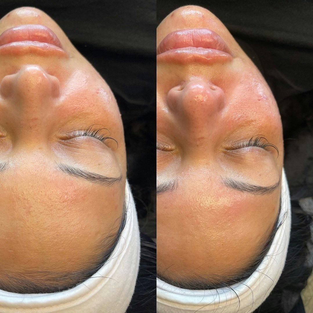 R&eacute;sultat HydraFacial Grain de Peau Affin&eacute; &mdash; Institut V Esth&eacute;tique Montr&eacute;al