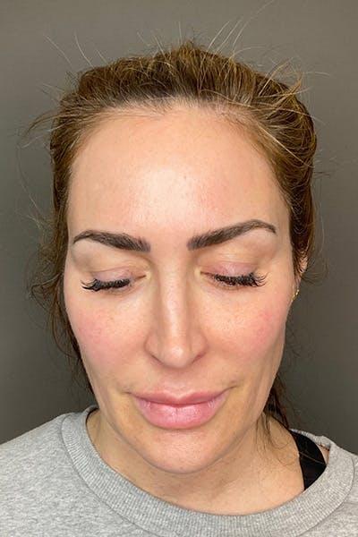 Avant HydraFacial signes &acirc;ge &mdash; Institut V Esth&eacute;tique Montr&eacute;al