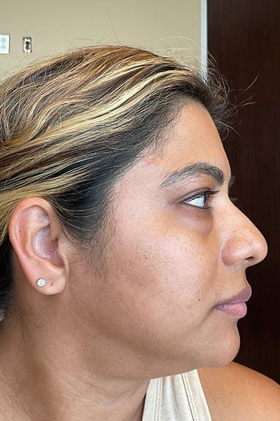 Avant HydraFacial pores dilat&eacute;s &mdash; Institut V Esth&eacute;tique Montr&eacute;al