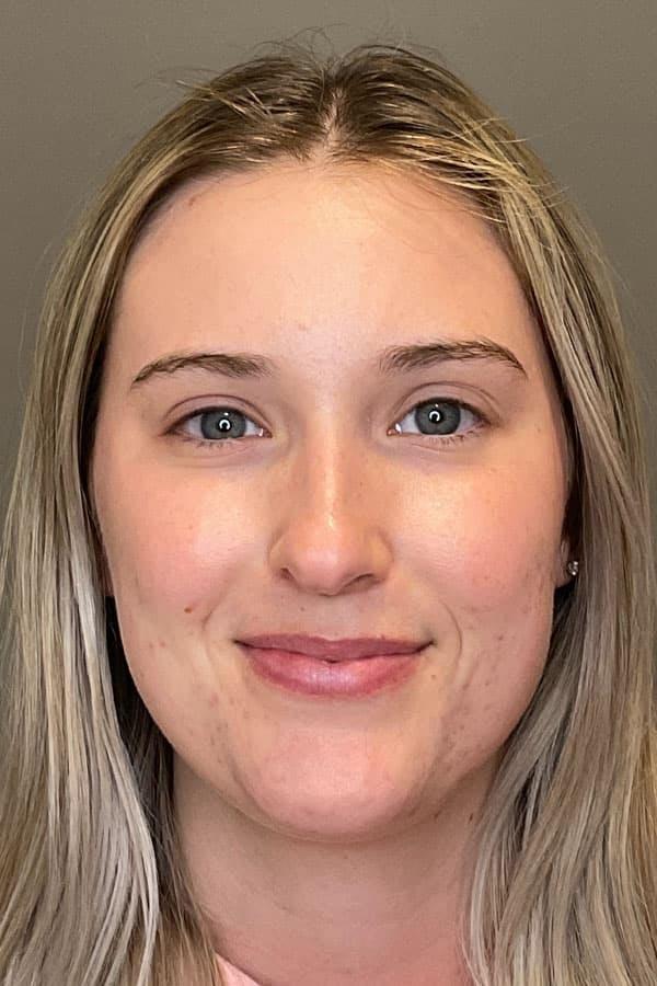 Avant HydraFacial Signature pores dilat&eacute;s &mdash; Institut V Esth&eacute;tique Montr&eacute;al