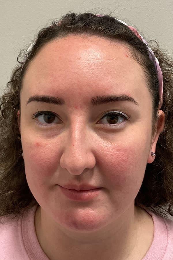 Avant HydraFacial texture irr&eacute;guli&egrave;re &mdash; Institut V Esth&eacute;tique Montr&eacute;al