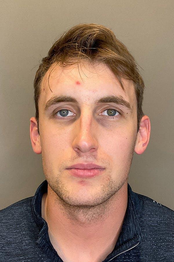 Avant HydraFacial texture irr&eacute;guli&egrave;re &mdash; Institut V Esth&eacute;tique Montr&eacute;al