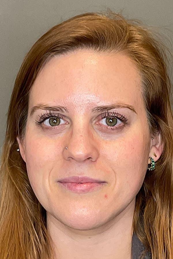 Apr&egrave;s HydraFacial anti-&acirc;ge &mdash; Institut V Esth&eacute;tique Montr&eacute;al