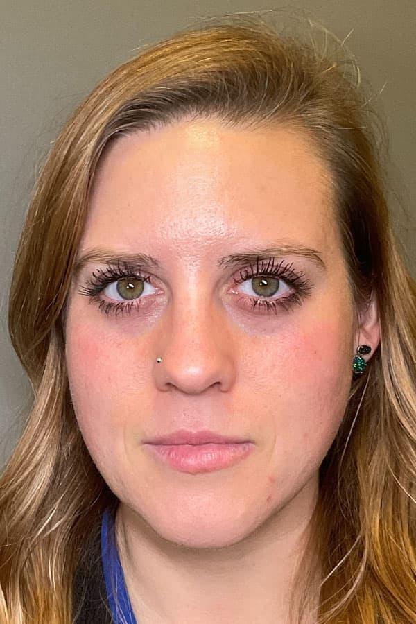 Avant HydraFacial signes &acirc;ge &mdash; Institut V Esth&eacute;tique Montr&eacute;al