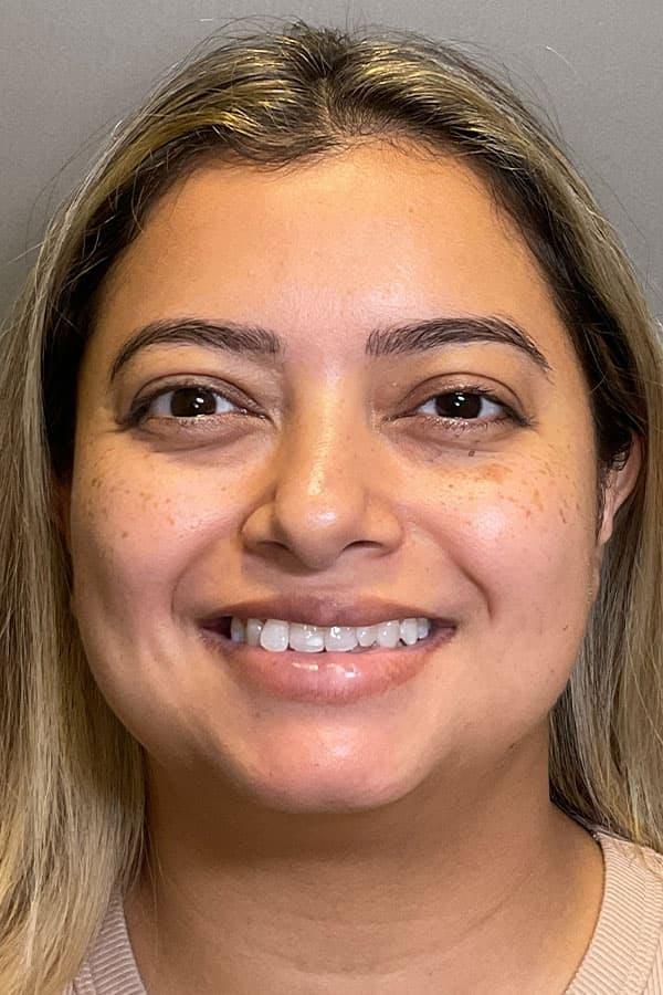 Avant HydraFacial peau d&eacute;shydrat&eacute;e &mdash; Institut V Esth&eacute;tique Montr&eacute;al