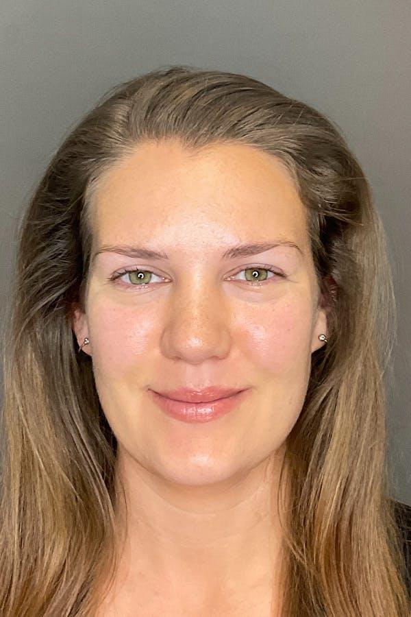 Avant HydraFacial teint terne &mdash; Institut V Esth&eacute;tique Montr&eacute;al