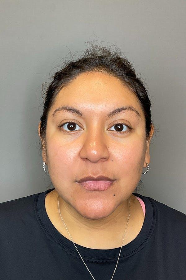 Apr&egrave;s HydraFacial r&eacute;duction acn&eacute; &mdash; Institut V Esth&eacute;tique Montr&eacute;al