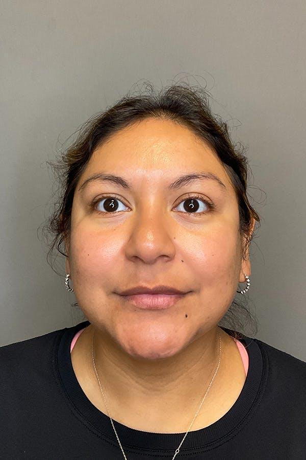 Avant HydraFacial acn&eacute; active &mdash; Institut V Esth&eacute;tique Montr&eacute;al