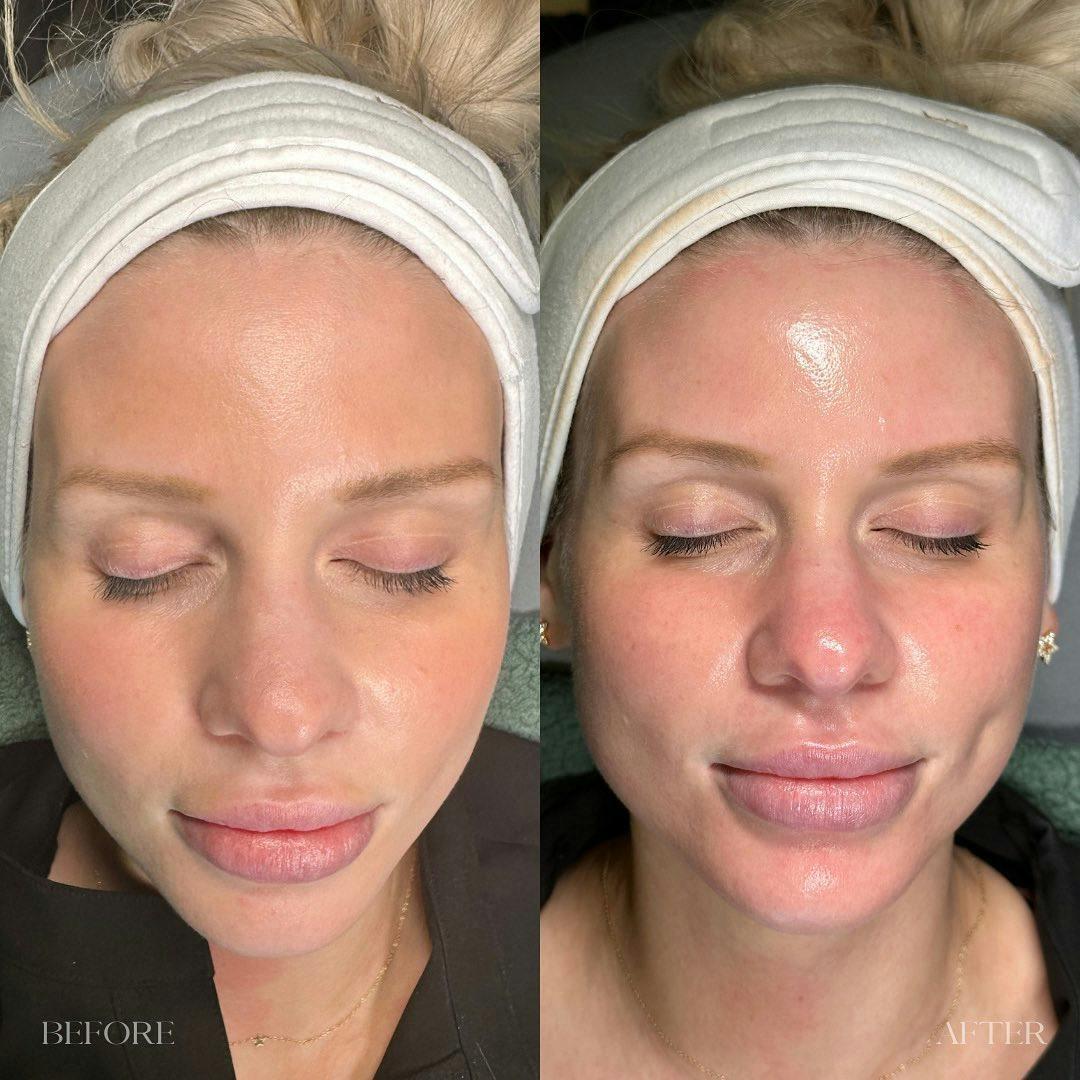 R&eacute;sultat HydraFacial Uniformit&eacute; du Teint &mdash; Institut V Esth&eacute;tique Montr&eacute;al