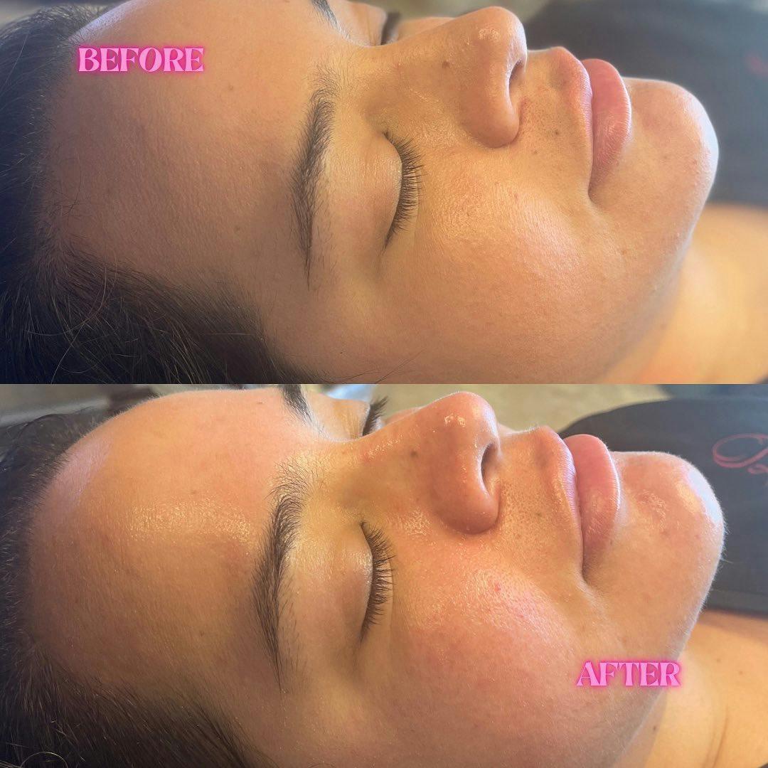 R&eacute;sultat HydraFacial Texture Douce et Lisse &mdash; Institut V Esth&eacute;tique Montr&eacute;al