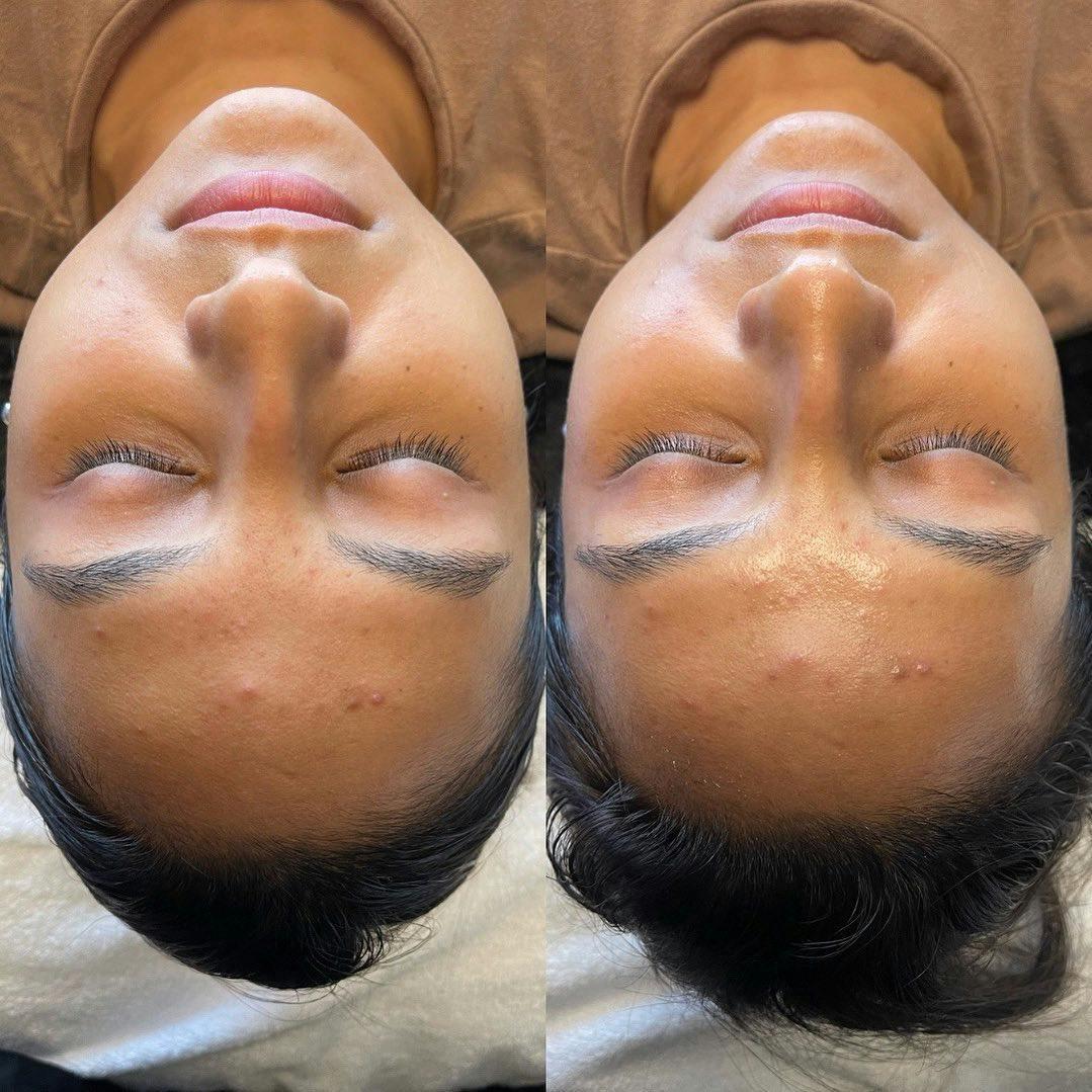 R&eacute;sultat HydraFacial &Eacute;clat Naturel &mdash; Institut V Esth&eacute;tique Montr&eacute;al