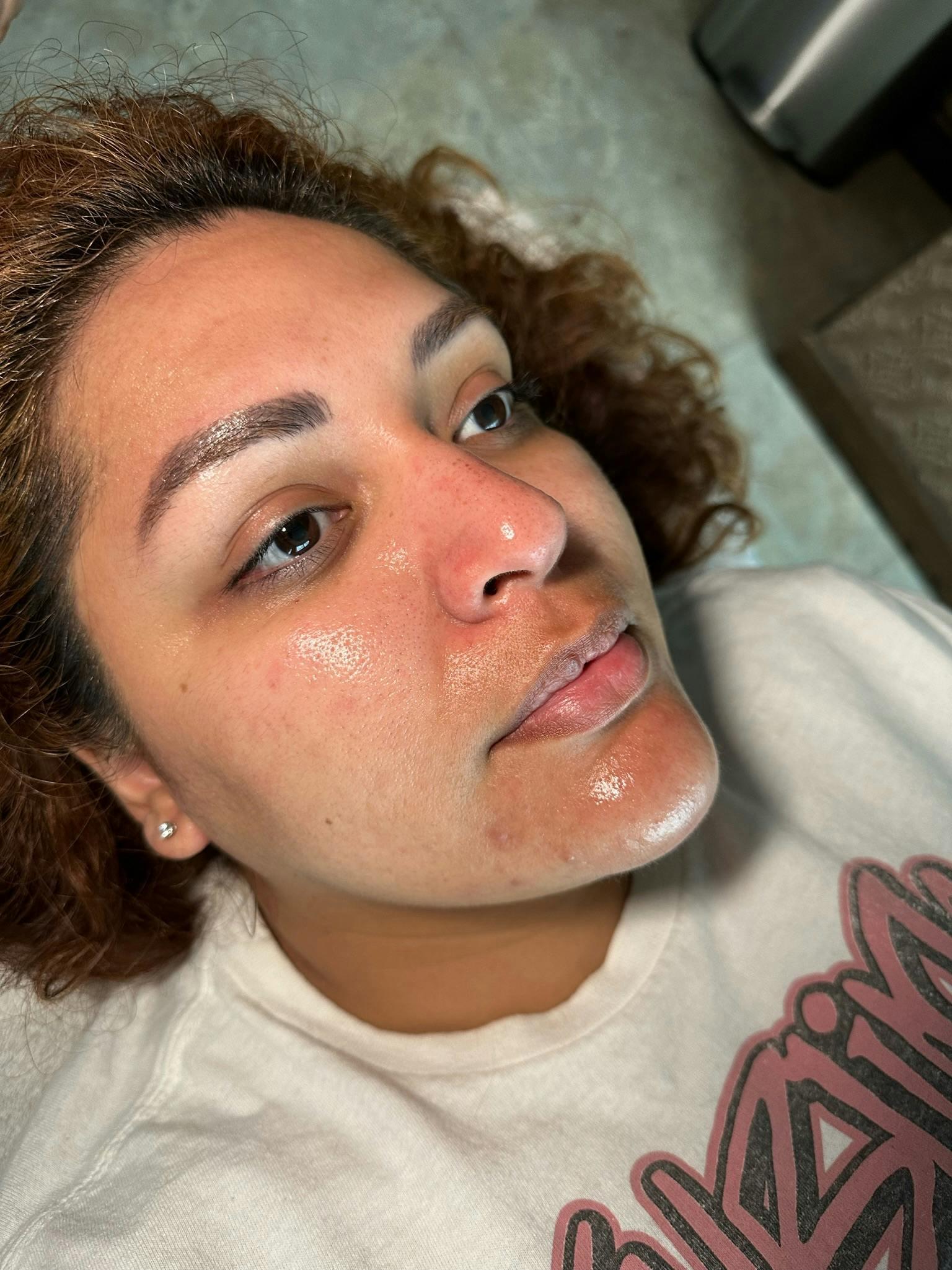 Apr&egrave;s HydraFacial Hydratation et &Eacute;clat &mdash; Institut V Esth&eacute;tique Montr&eacute;al