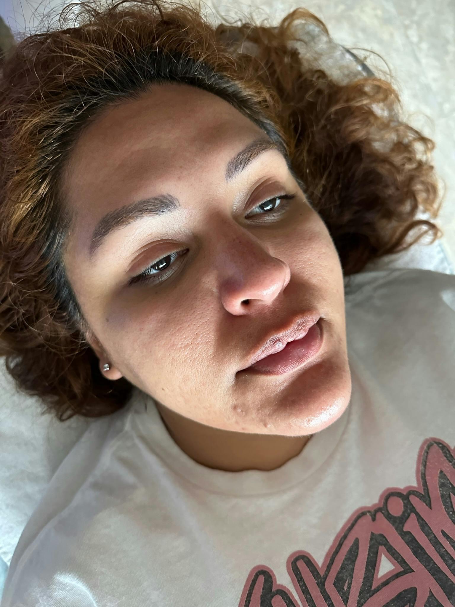 Avant HydraFacial Hydratation et &Eacute;clat &mdash; Institut V Esth&eacute;tique Montr&eacute;al