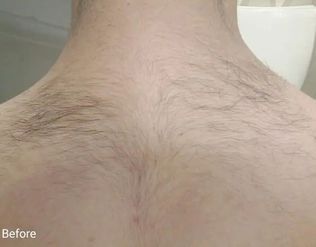 R&eacute;sultat &eacute;pilation laser nuque / dos du cou avant &mdash; Clarity II Institut V Esth&eacute;tique Montr&eacute;al