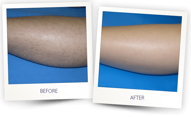 Avant et après épilation laser jambes Clarity II — Institut V