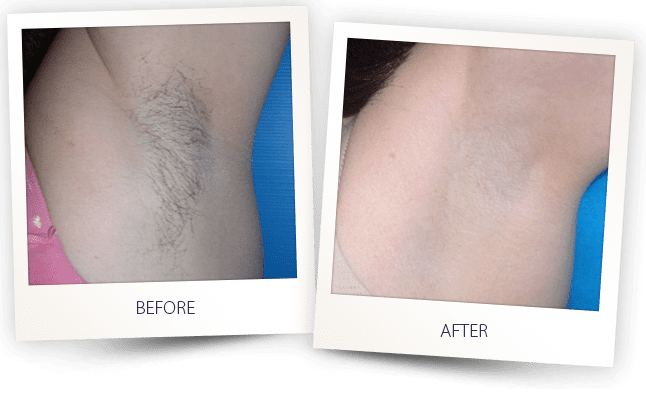 Avant et après épilation laser aisselles Clarity II — Institut V