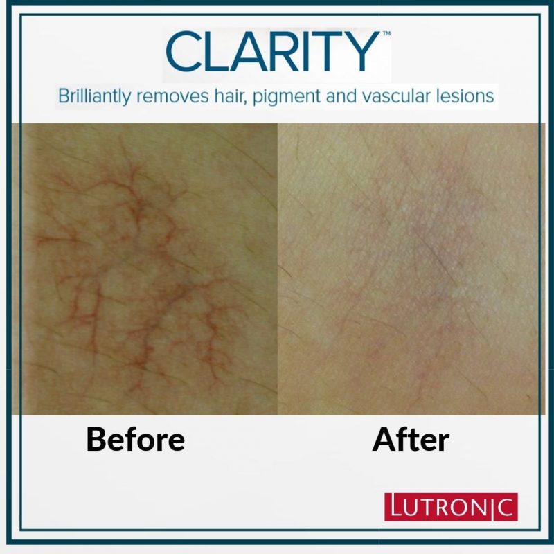 R&eacute;sultat &eacute;pilation laser traitement des veines d'araign&eacute;e avant et apr&egrave;s &mdash; Clarity II Institut V Esth&eacute;tique Montr&eacute;al