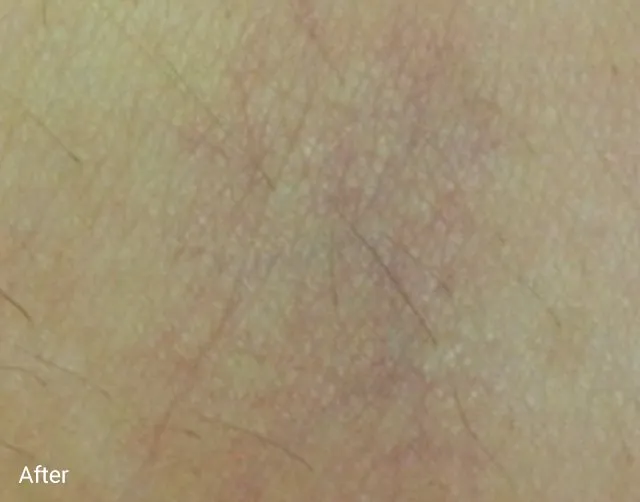 R&eacute;sultat &eacute;pilation laser lésion vasculaire apr&egrave;s &mdash; Clarity II Institut V Esth&eacute;tique Montr&eacute;al