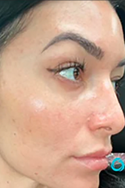 Apr&egrave;s &mdash; Marques d'acn&eacute; (profil lat&eacute;ral)