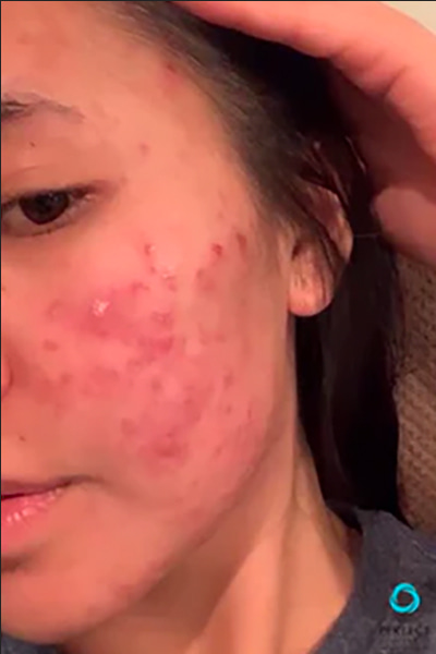 Avant &mdash; Cicatrices d'acn&eacute; (joues)