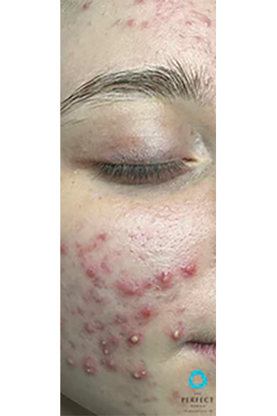 Avant &mdash; Acn&eacute; kystique (gros plan)