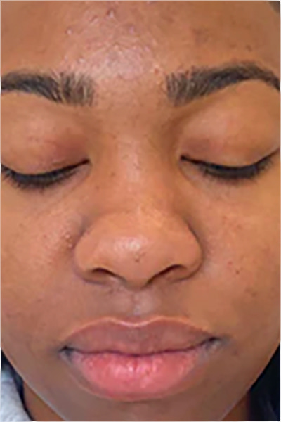 Après traitement peeling chimique hyperpigmentation — Institut V