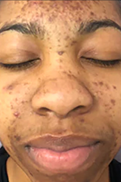 Avant traitement peeling chimique hyperpigmentation — Institut V