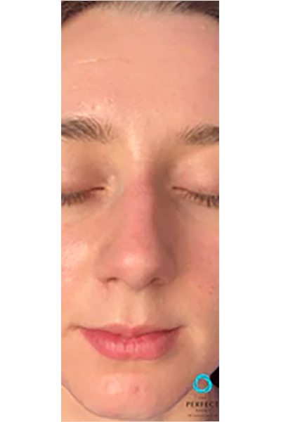 Apr&egrave;s &mdash; Traitement acn&eacute; s&eacute;v&egrave;re