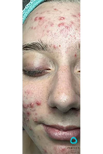 Avant &mdash; Traitement acn&eacute; s&eacute;v&egrave;re