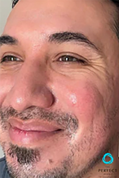 Apr&egrave;s &mdash; Rajeunissement cutan&eacute;