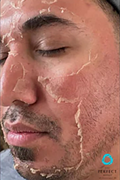 Avant &mdash; Rajeunissement cutan&eacute;