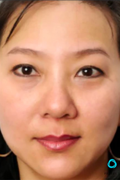 Après traitement peeling chimique texture peau — Institut V